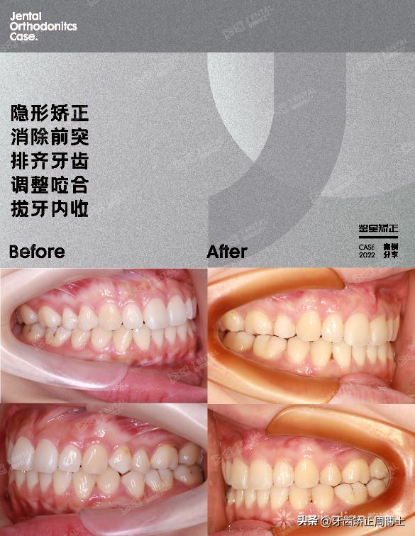 隐形矫正龅牙效果图,严重龅牙可以用隐形矫正吗