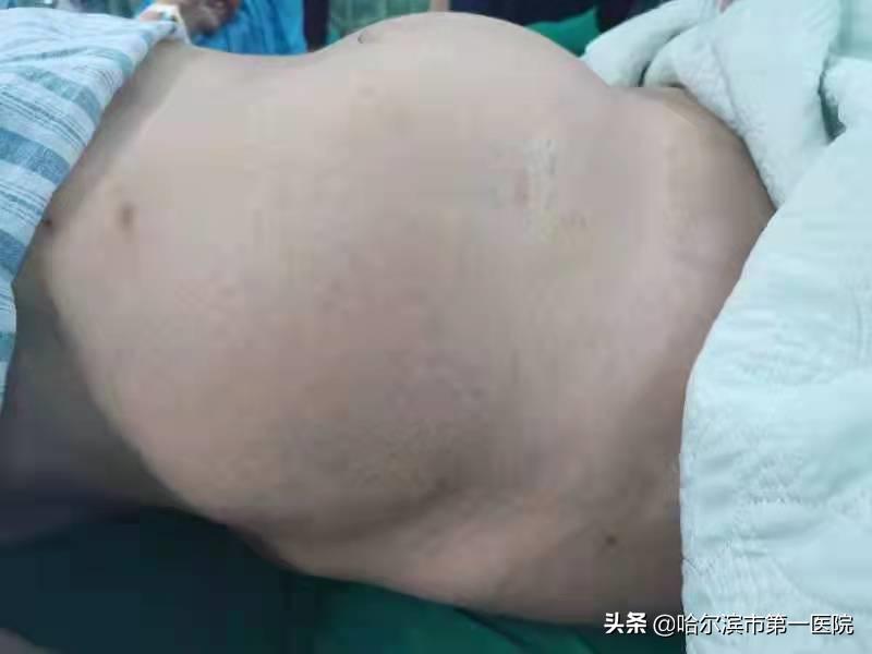 82岁老太肚子鼓包如足月孕妇原是“肿瘤”作怪—哈尔滨市第一医院妇二科利用“单孔腹腔镜”切除巨大卵巢肿瘤