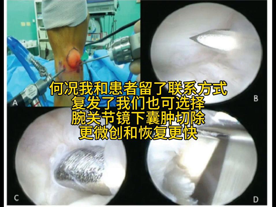 好吧来发个腱鞘囊肿的科普吧#腱鞘囊肿的治疗