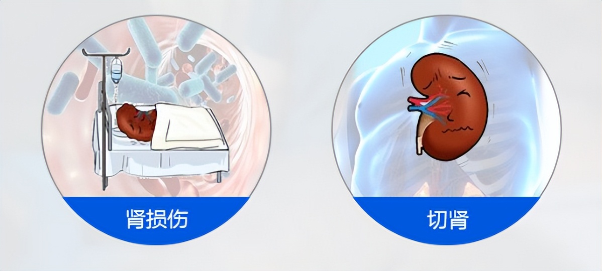 肾结石是不是经常发作,肾结石有石头不痛要治吗