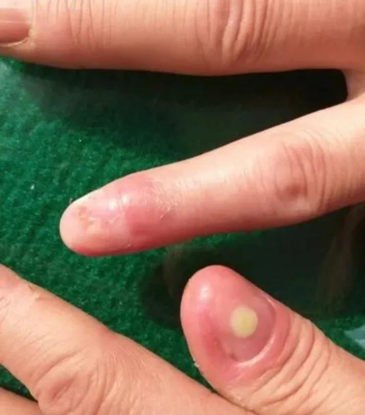 春节的这个节目是必备的，导致老吴指甲化脓感染，这个锅谁背？