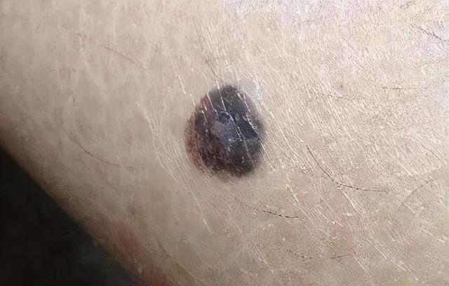 医生提醒这几种痣要警惕,黑痣长在这3个部位建议高度警惕