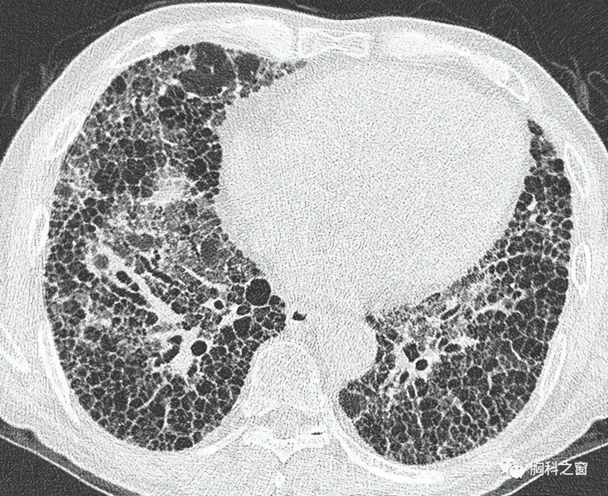 肺间质纤维化的护理诊断及措施,肺纤维化预防措施