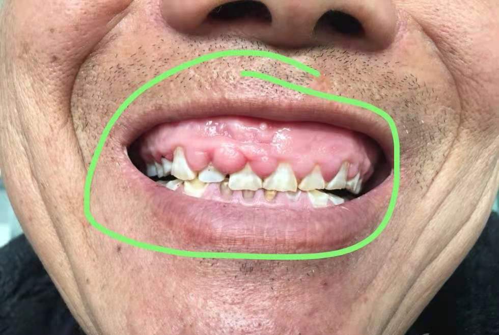 不会引起牙龈增生的降压药有哪些,吃地平类降压药牙龈增生怎么办