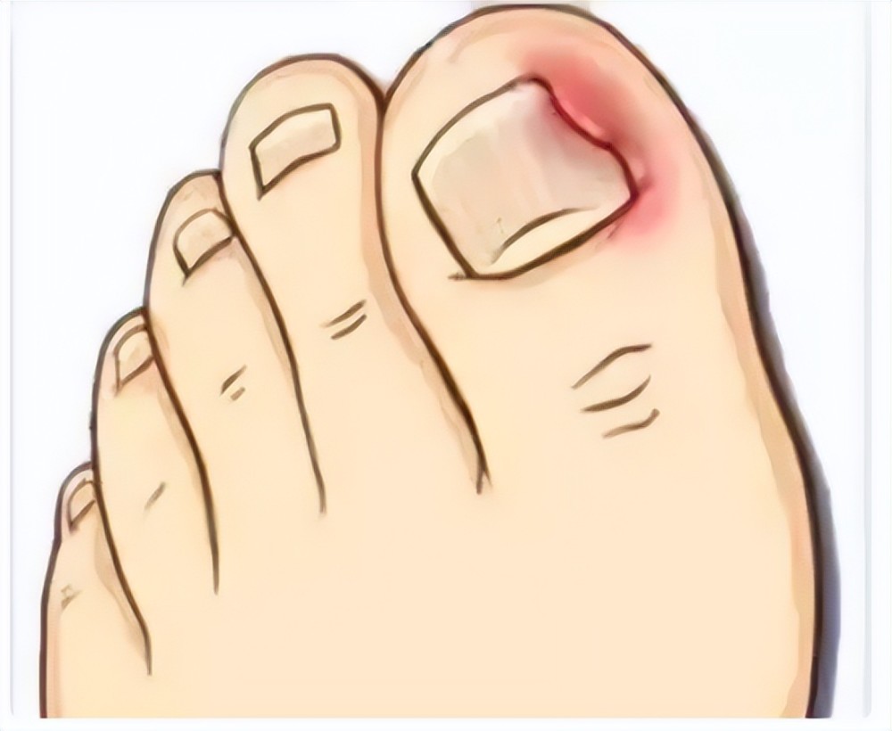 甲沟炎痛的无法剪指甲怎么办,甲沟炎清理过了为什么还是痛