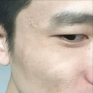 28岁小伙三次治疗痘坑，终于摆脱自卑，变得自信阳光