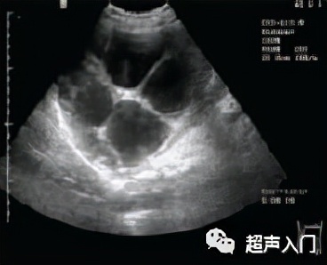 肝包虫病B超能检查出来吗?