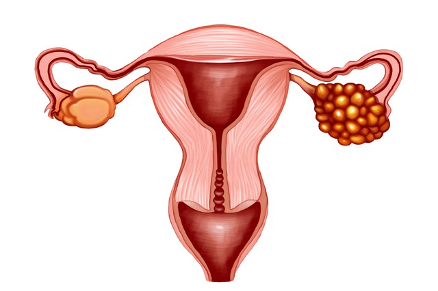 巧克力囊肿中医治疗真的没效果吗,巧克力囊肿吃中药软坚散结