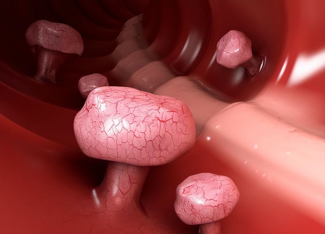 形成囊肿了该怎么把囊肿消下去呢,医生提醒大多数囊肿无需处理