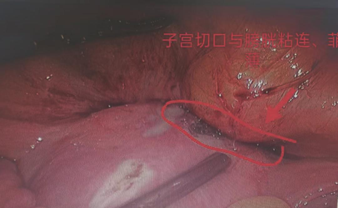 瘢痕妊娠的病因病机,瘢痕妊娠超声诊断标准