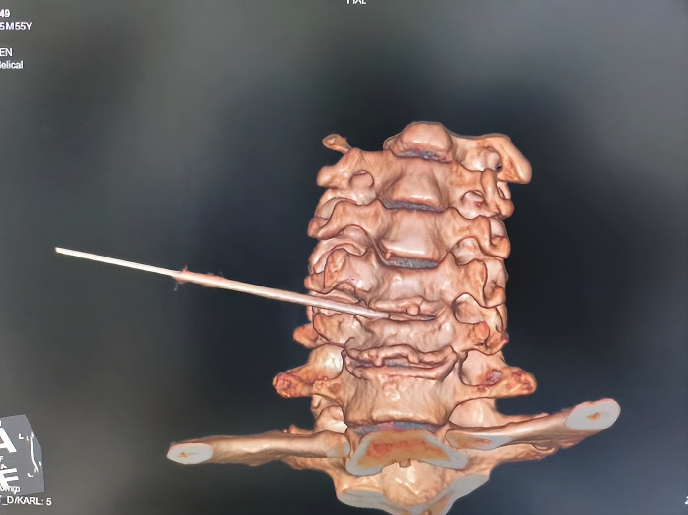 西安市红会医院北院区做微创手术,西安红会医院肌骨超声科