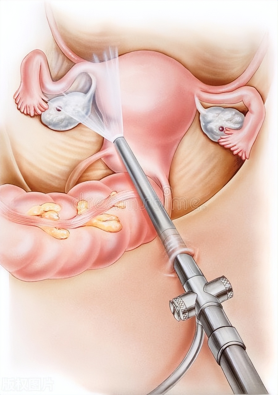包皮过长会导致宫颈癌吗,丈夫包皮过长或包茎老婆得宫颈癌