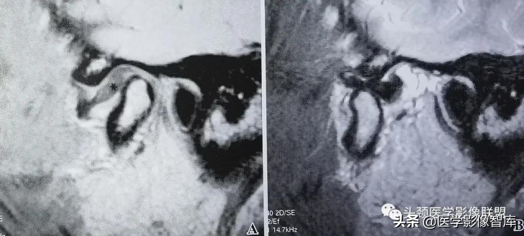 颞下颌关节移位怎么处理,颞下颌关节盘变形怎么治疗
