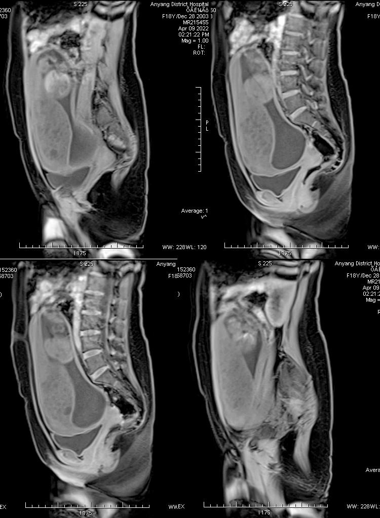 这么典型的葡萄胎MRI影像，快来学习吧