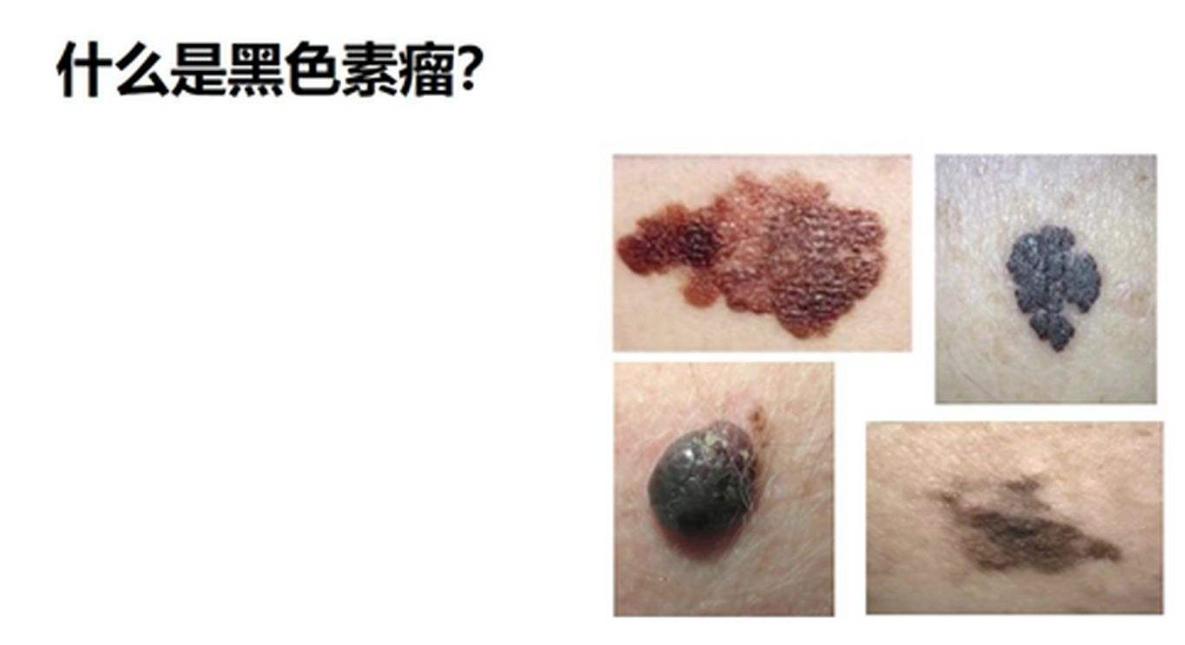 抗癌最新突破消息治肺癌,抗癌最新突破