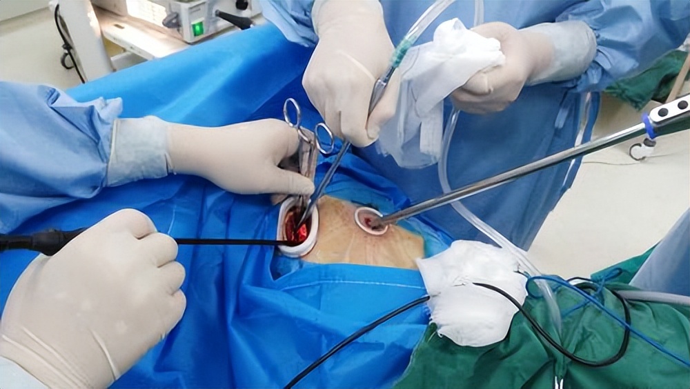 全胸腔镜下，与右侧开胸小切口房间隔缺损修补术的临床结果分析