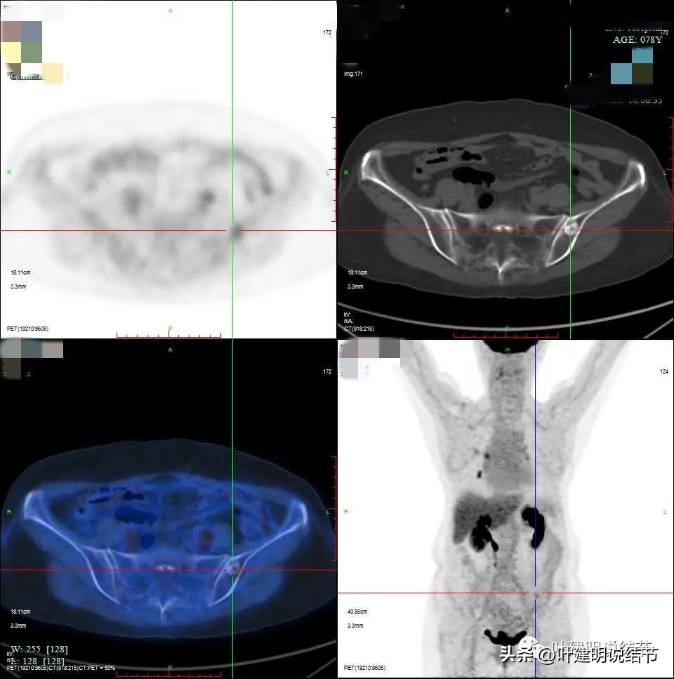 79岁肺癌早期手术风险,75岁早期浸润性肺癌还要治疗吗