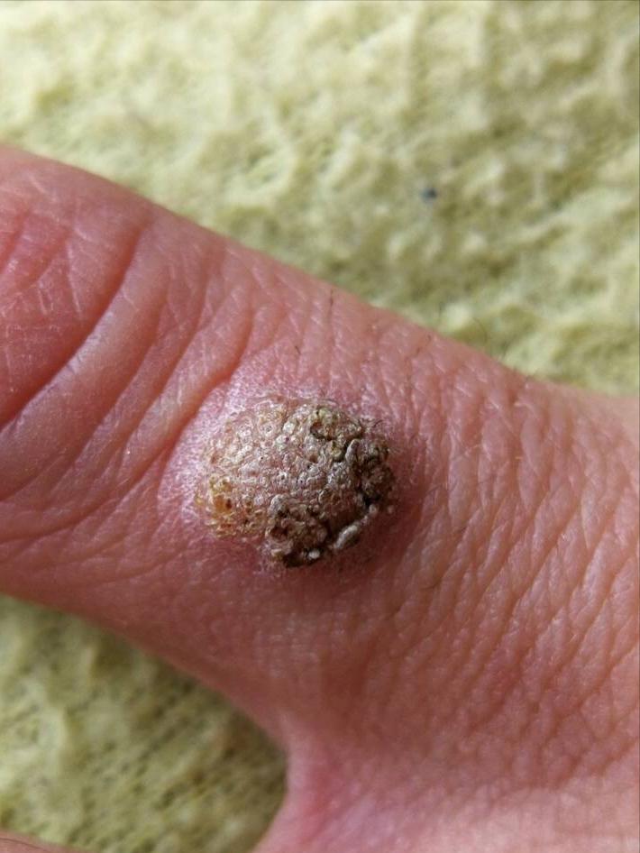 派特灵治疗hpv骗局是真的吗,派特生物能治疣吗