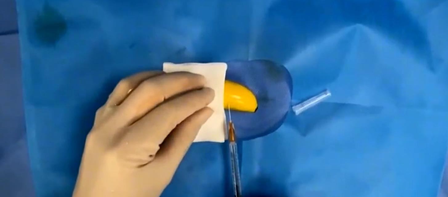 2016年，长春20岁大学生做包皮手术导致死亡，事故原因究竟为何？