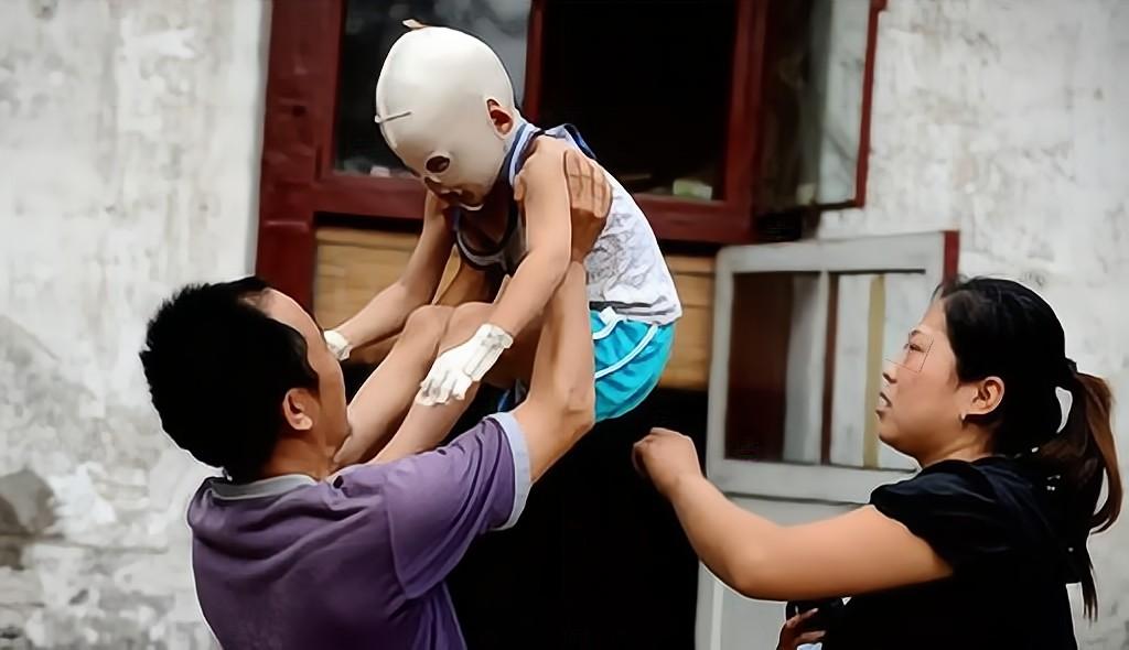 小孩子脸被火烧伤戴着面具,因烧伤带面具的山西小男孩