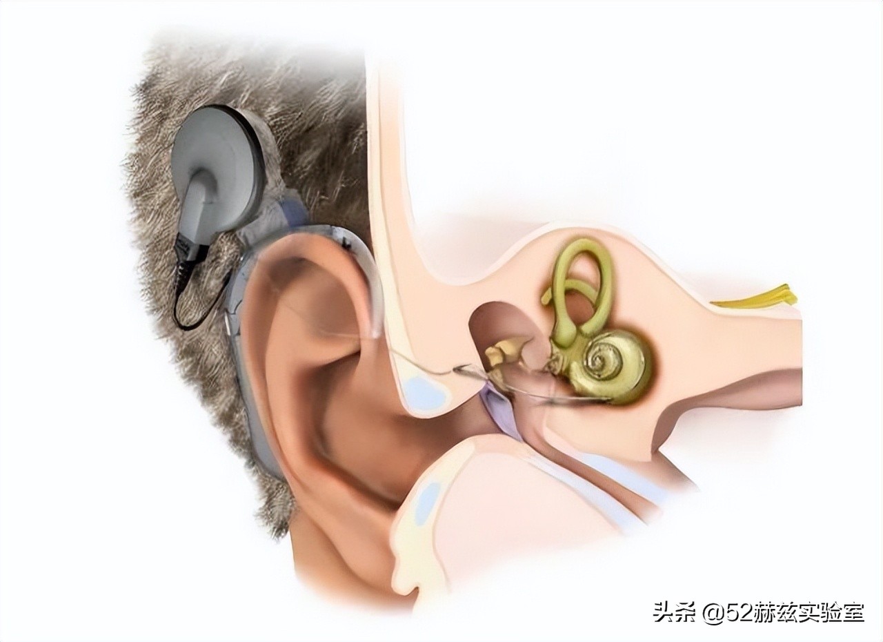 人工耳蜗进口最贵多少钱,进口人工耳蜗价格表