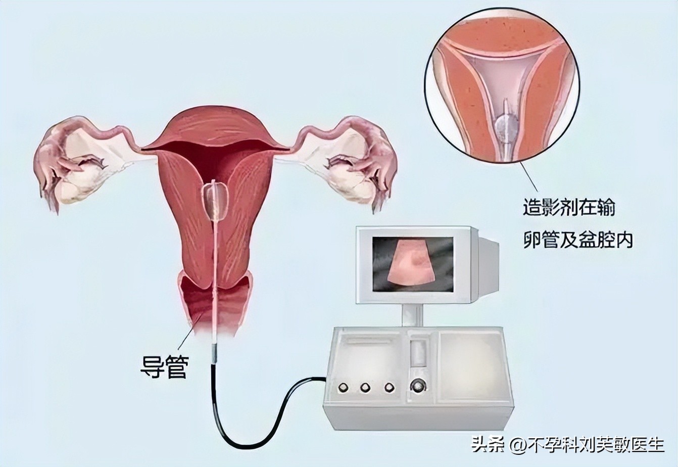 输卵管粘连还能怀孕吗,多囊加输卵管粘连可以自然受孕吗