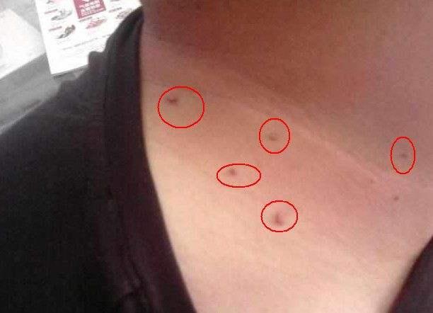 如果癌症转移骨髓有什么症状,癌症一旦转移到骨头生存期