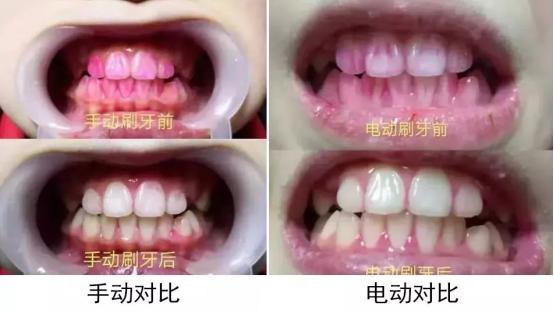 电动牙刷对牙齿有什么好处和坏处,电动牙刷的好处与坏处