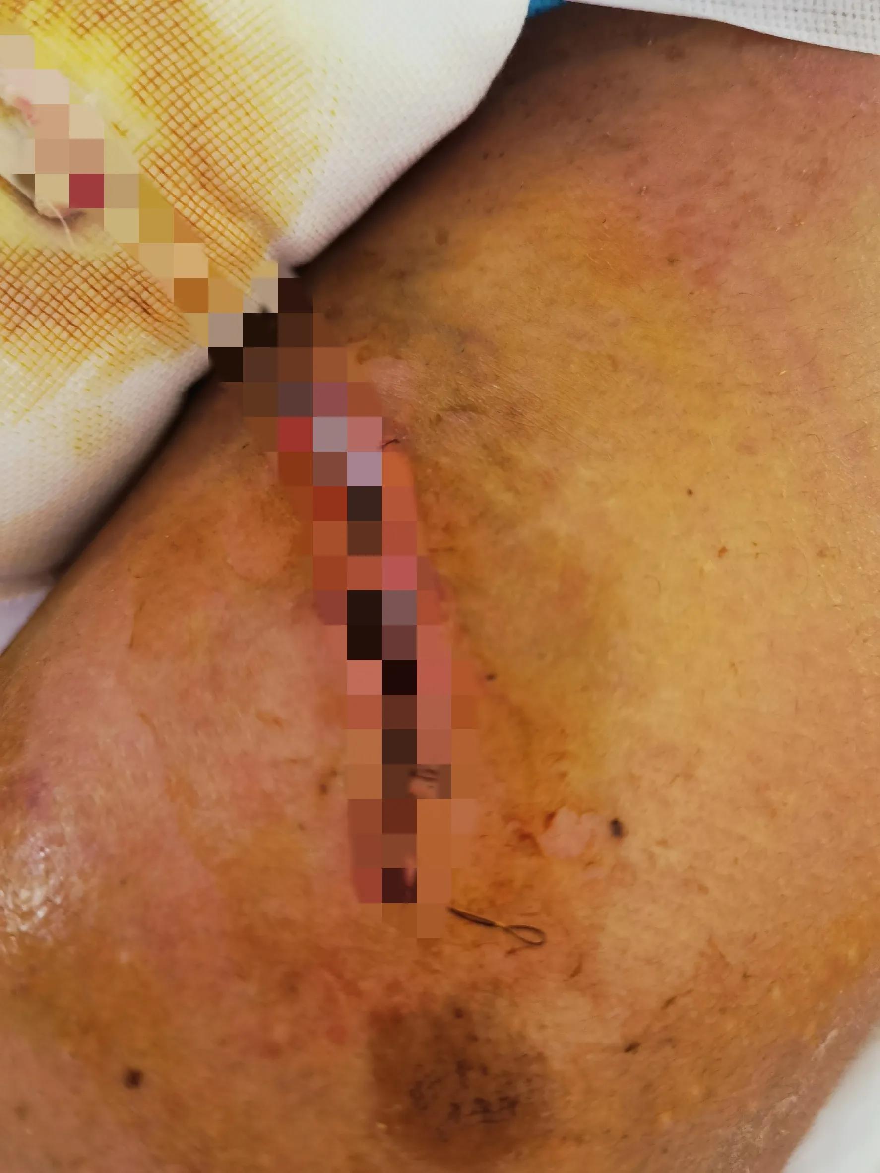 骨折手术细菌感染严重吗,骨折手术感染早期症状