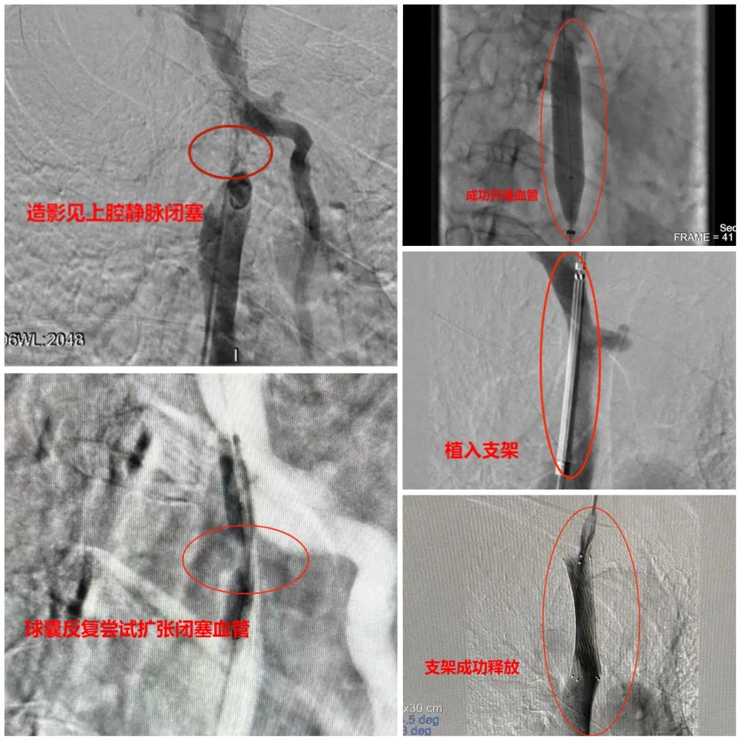 警惕老人脸肿,警惕中风年轻化