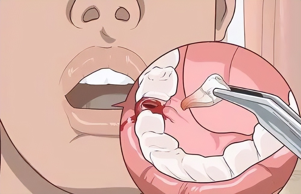 拔牙后频繁地吞口水会影响出血量吗？