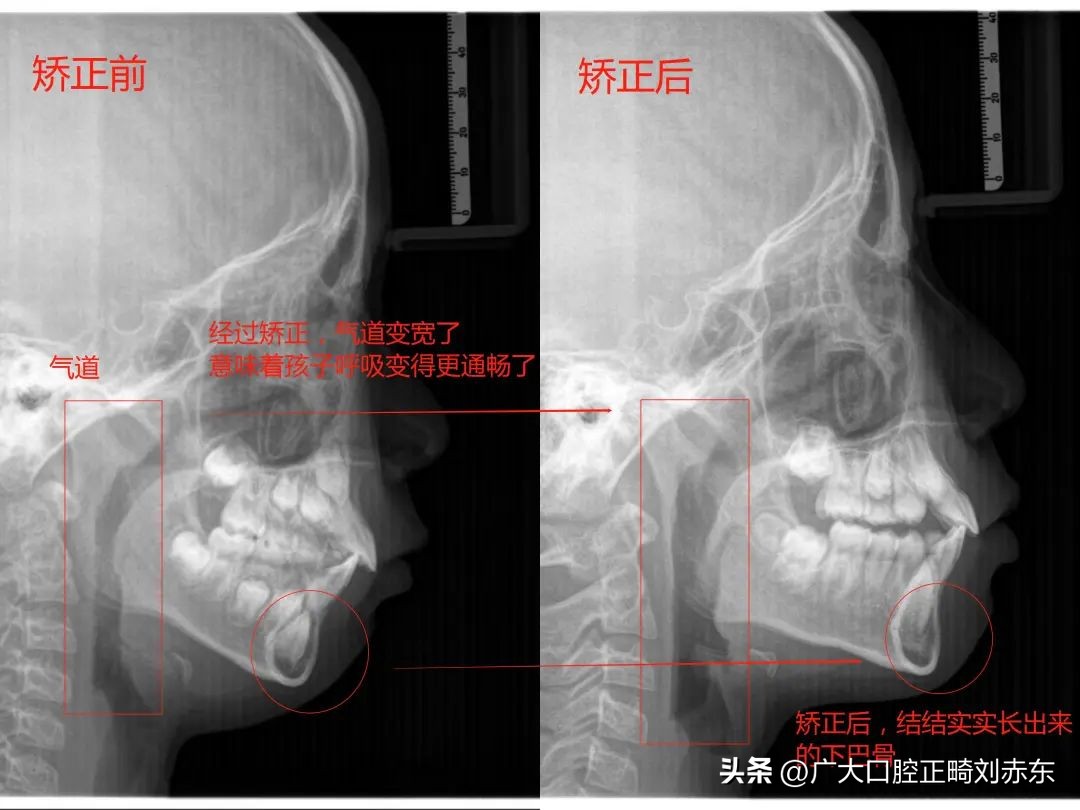 成年以后再矫牙？专家：太迟了，下巴后缩最佳治疗时间是这个时候