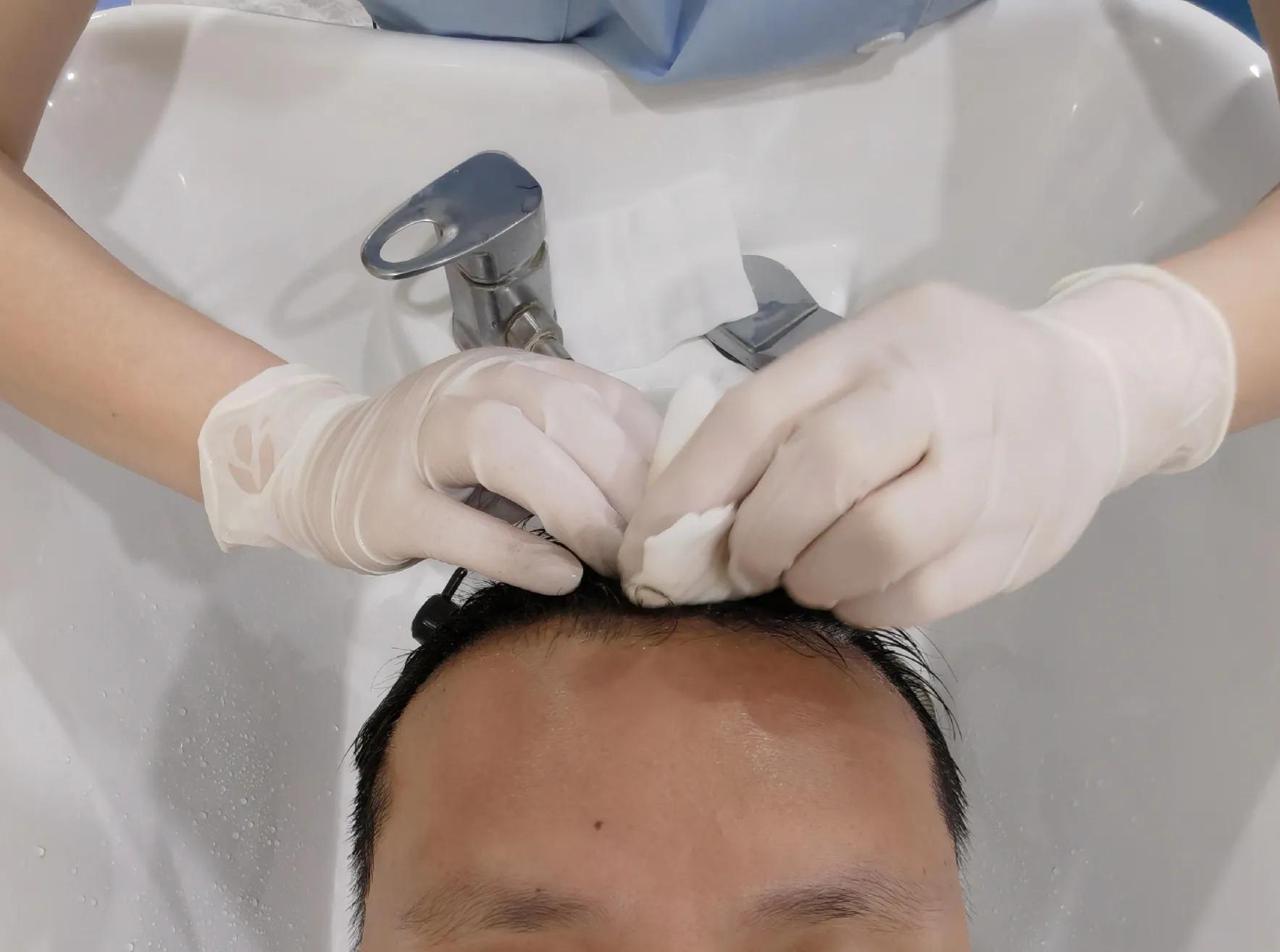 雄脱植发的亲身经历和感受,16000字讲述植发真实感受