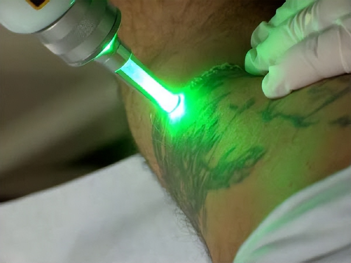 纹身能完全洗掉多少钱,纹身能彻底洗掉多少钱