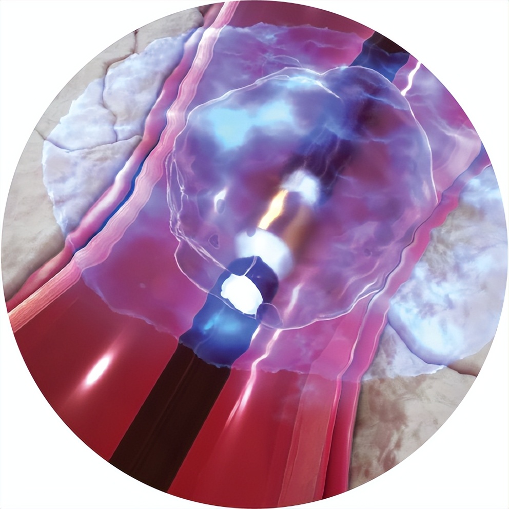 血管衰老的克星,血管钙化能做支架吗