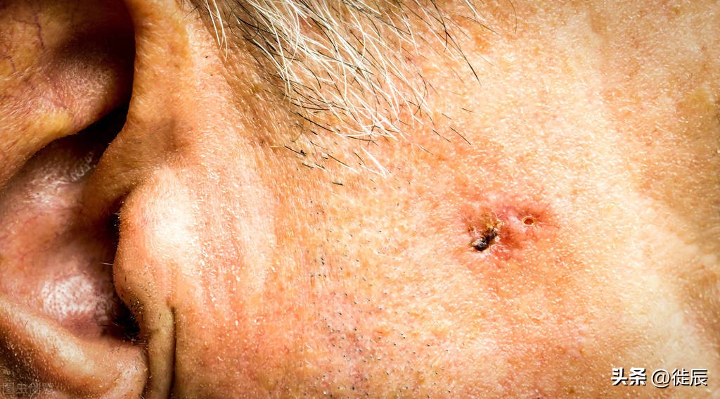 体表肿瘤,基底细胞癌快死的征兆