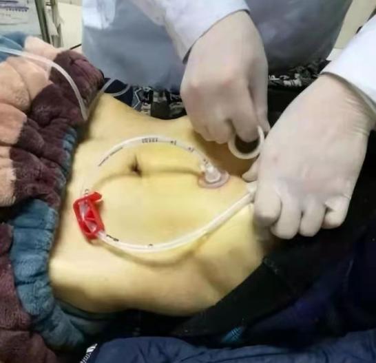 经皮胃镜下胃造瘘术操作步骤,什么是经皮内镜下胃造瘘