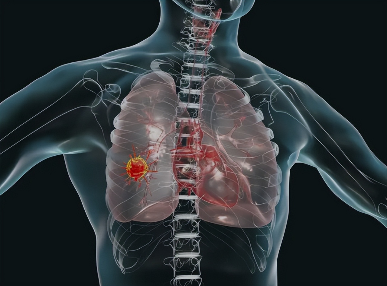 肺癌晚期加尿毒症晚期能活多久,肺癌晚期的症状一般还能活多久