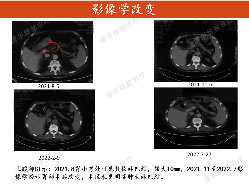 83岁高龄患印戒细胞癌，是细胞治疗让他多一个治疗手段