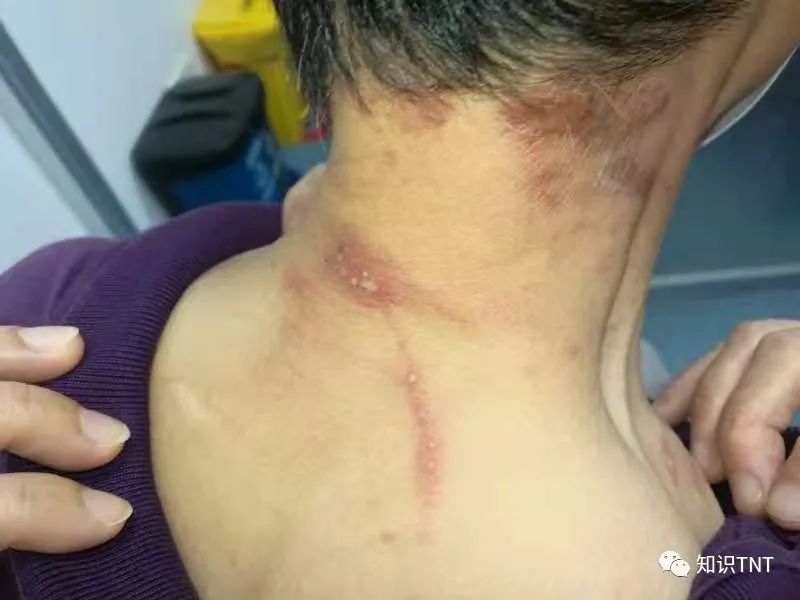 隐翅虫主要分布地区,隐翅虫一般出现在哪些地方