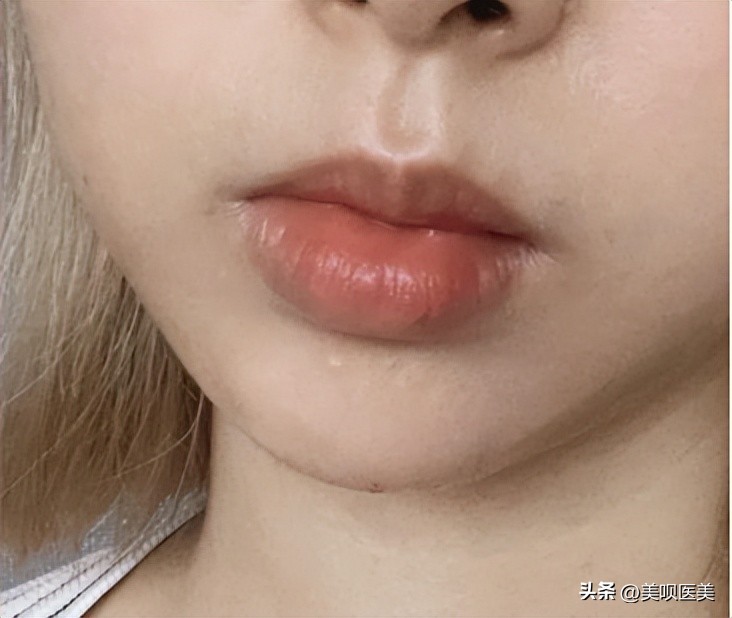 玻尿酸大分子能打脸吗,网红玻尿酸真的能改变肌肤吗