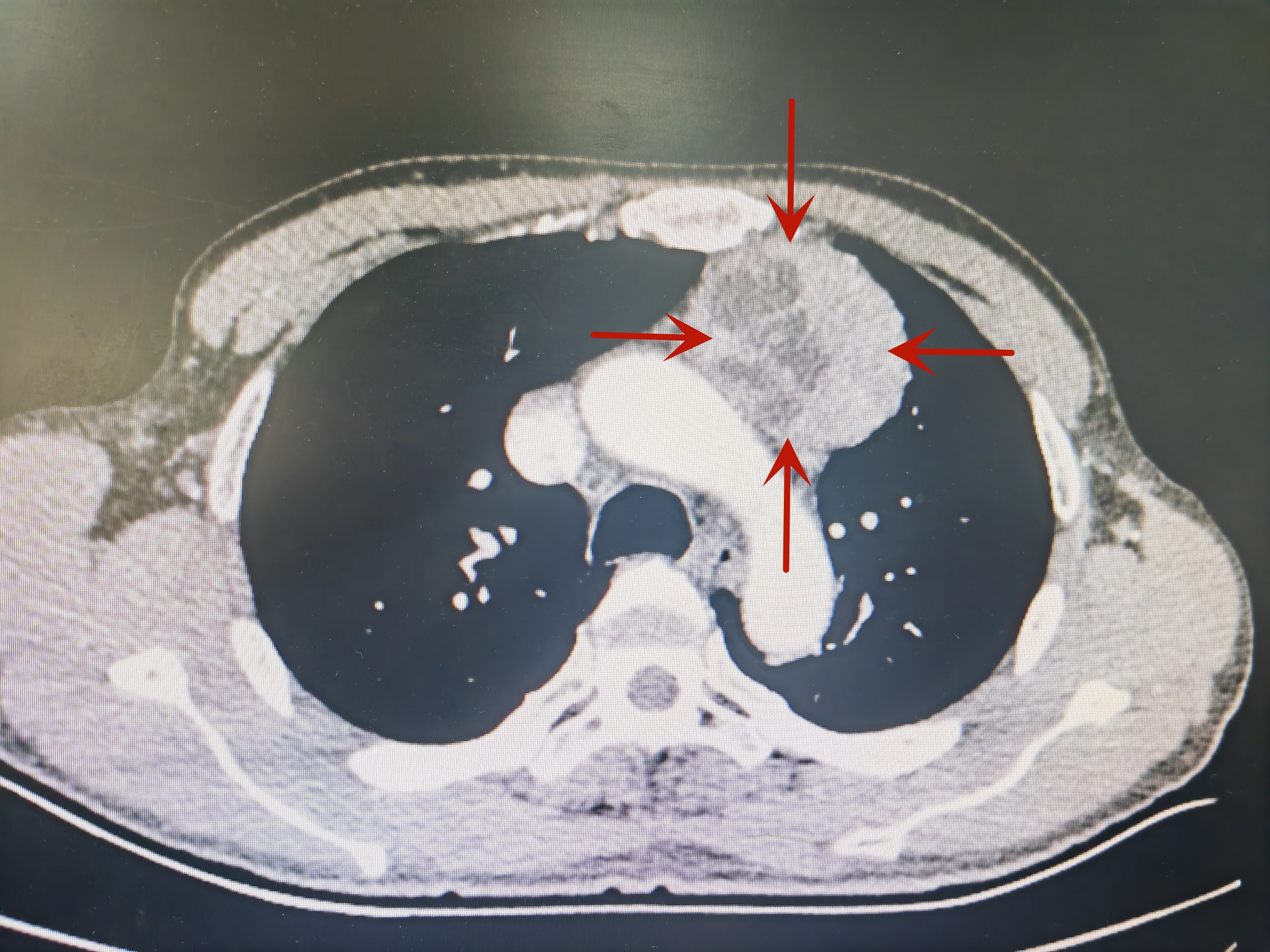 挑战高难度！定西市人民医院胸外科成功完成我市首例胸腔镜经剑突下纵隔肿瘤切除术