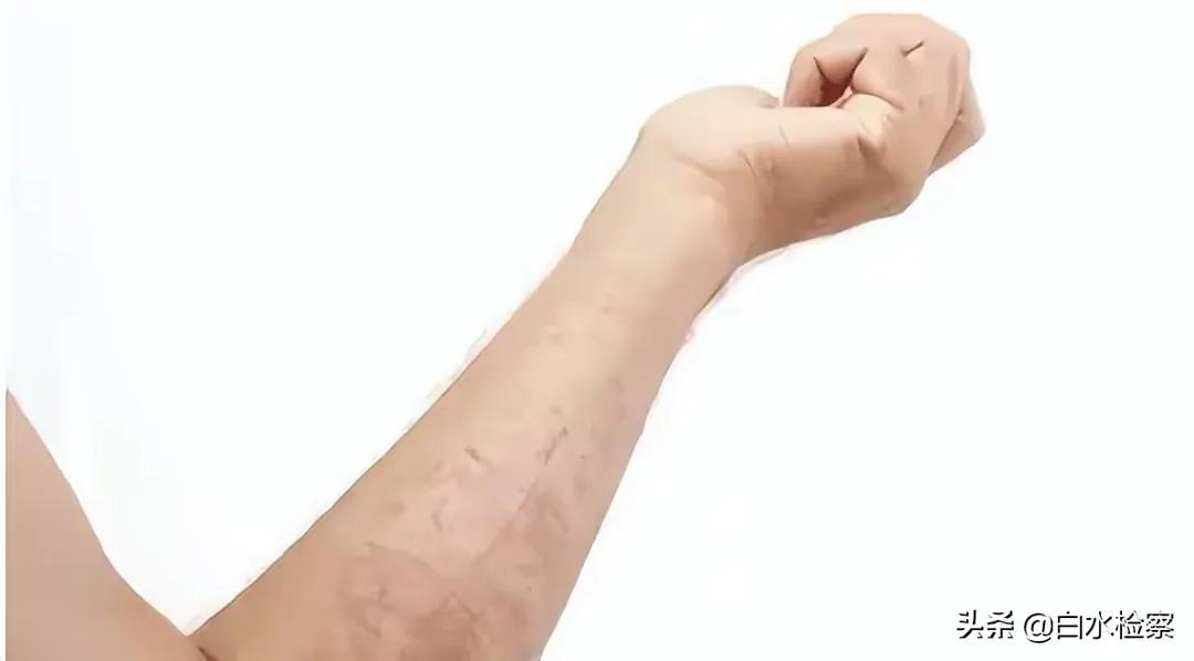 孩子药浴洗出绝症母亲肠子悔青,给孩子洗药浴洗出绝症