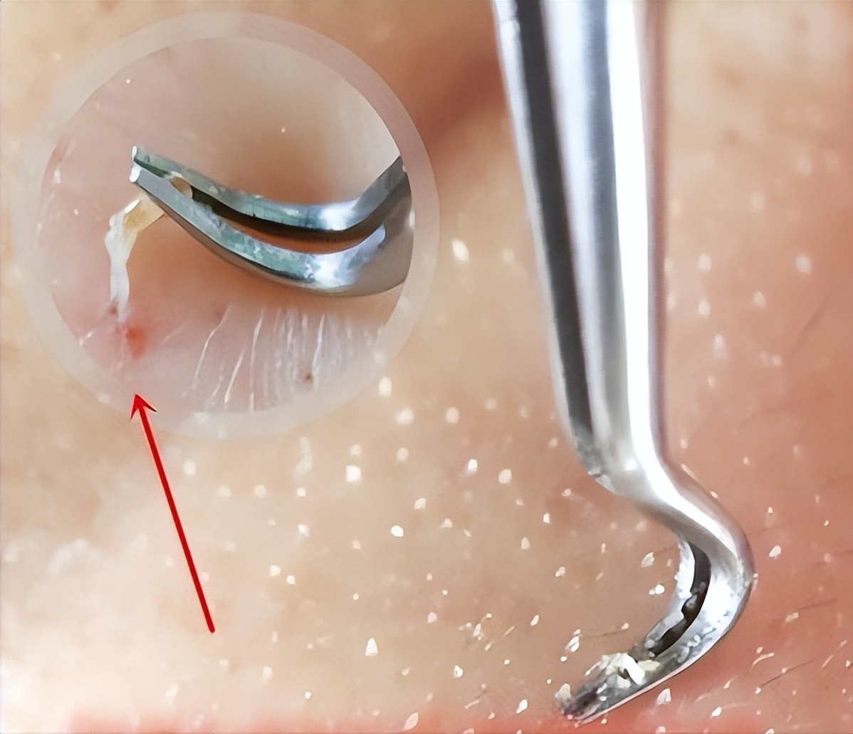 鼻子的黑头跟草莓一样,草莓黑头怎么去除最有效