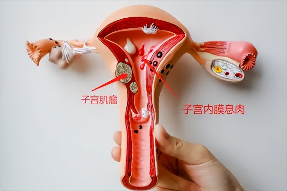 体检发现有息肉，离癌症还有多远？我彻底方了...