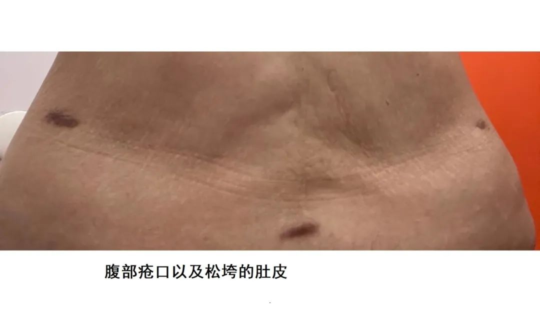 鍘﹂棬鏁村舰缇庡鍖婚櫌鎶借剛,鍘﹂棬鍗庣編鍖婚櫌涓嬪反鎶借剛