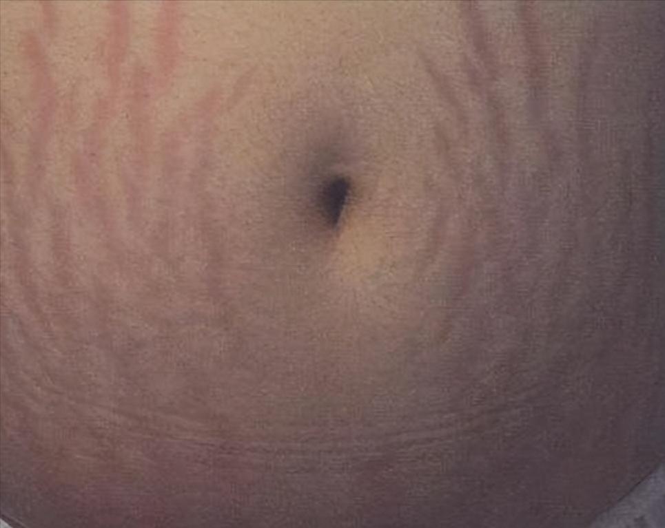 怎么消肥胖纹？吉首俪人教你