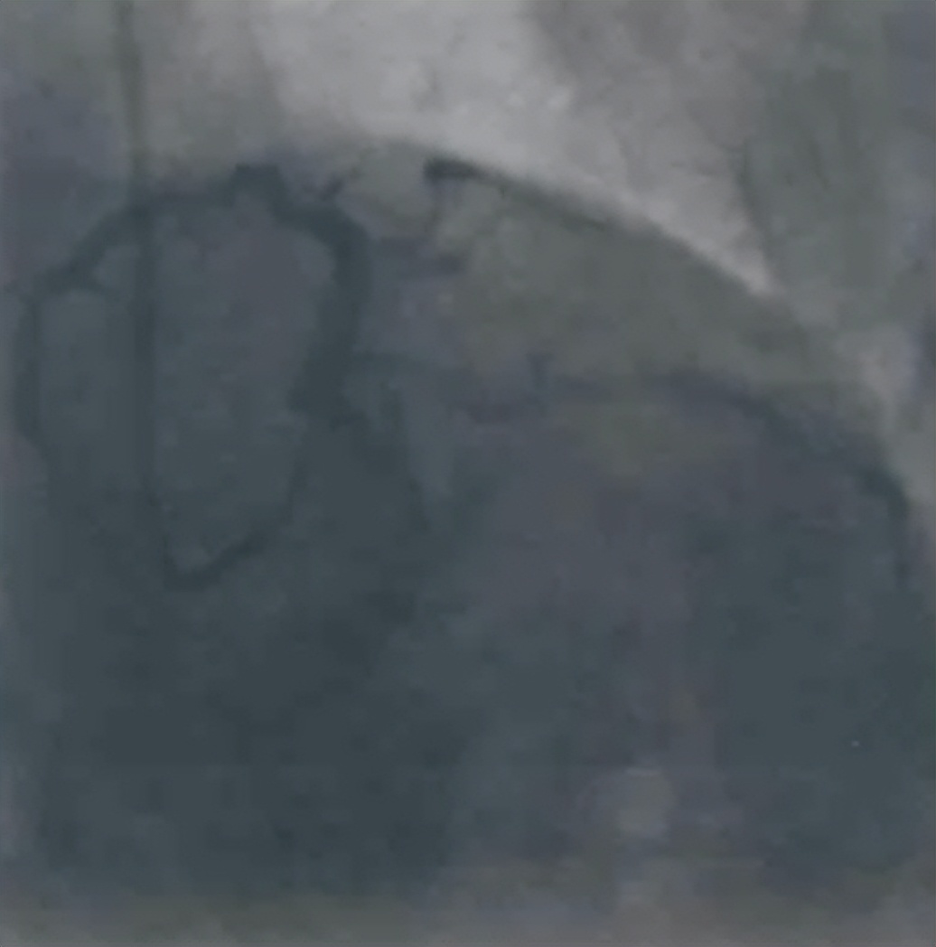 急诊PCI指南,急诊pci治疗费用