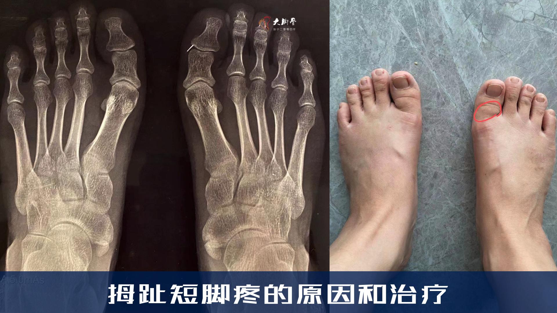 大拇脚趾短粗怎么改善,拇外翻手术大脚趾变短怎么办