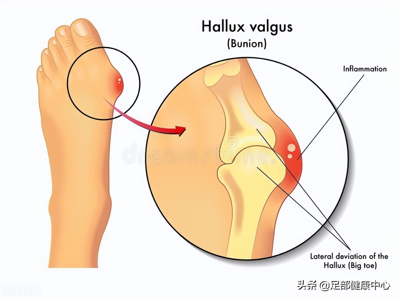 常见大拇趾疼痛原因,女性脚趾拇疼痛预示十种疾病